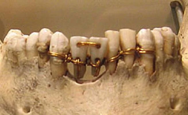 Fotografía de una mandíbula que muestra el uso de alambres de oro como método dental antiguo, evidencia clave en la historia del empaste dental y prótesis tempranas. Autor: desconocido.