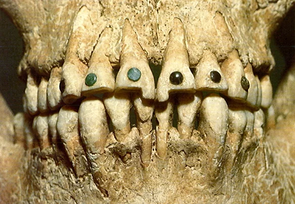 Imagen de una mandíbula precolombina que muestra incrustaciones dentales con piedras preciosas, una práctica ancestral que forma parte de la historia del empaste dental. Autor: desconocido.