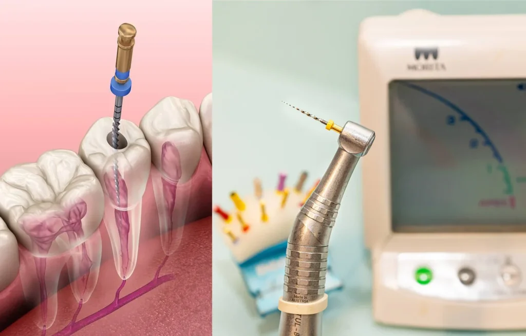 Ilustración de un tratamiento de conducto con lima rotatoria dentro del diente y fotografía de un instrumento rotatorio de níquel-titanio junto a un localizador de ápice dental. Autor: desconocido.